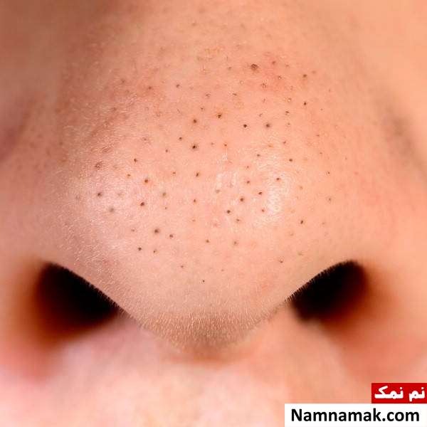 آموزش تخلیه جوش سر سیاه بینی در منزل