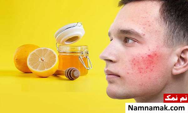 طرز تهیه ماسک برای جوش سر سیاه بینی طرز تهیه ماسک برای جوش سر سیاه بینی