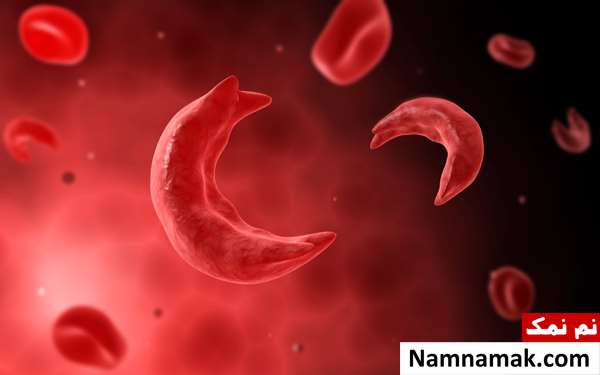 طول عمر بیماران کم خونی داسی شکل طول عمر بیماران کم خونی داسی شکل