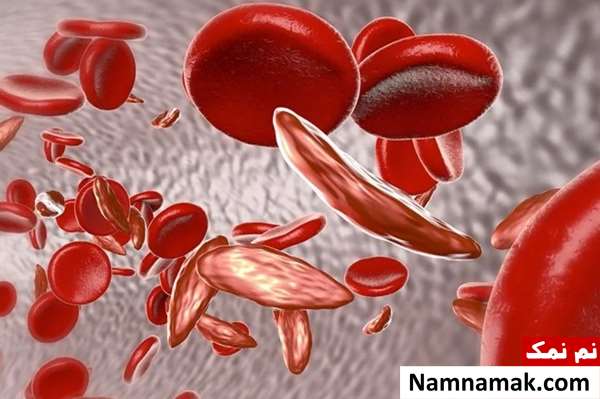 طول عمر بیماران کم خونی داسی شکل طول عمر بیماران کم خونی داسی شکل
