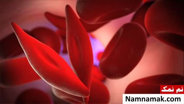 آیا کم خونی داسی شکل خطرناک است؟ آیا کم خونی داسی شکل خطرناک است؟
