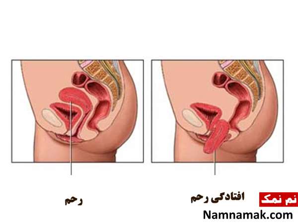 افتادگی رحم بعد از زایمان طبیعی
