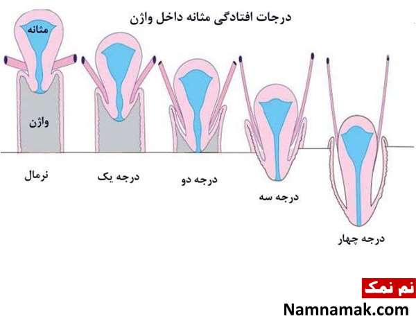 افتادگی رحم بعد از زایمان طبیعی