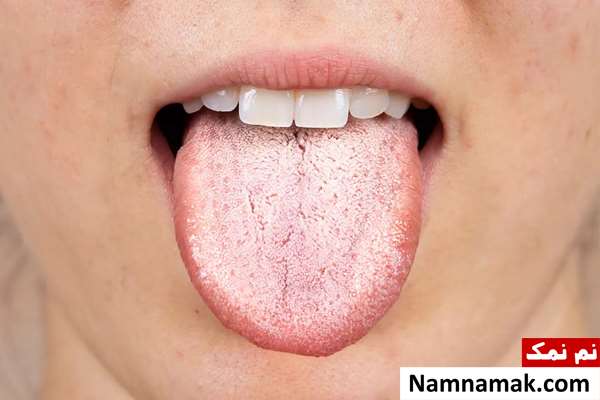 علت و درمان سفیدی و سوزش زبان در طب سنتی