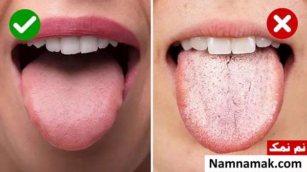 علت و درمان سفیدی و سوزش زبان در طب سنتی