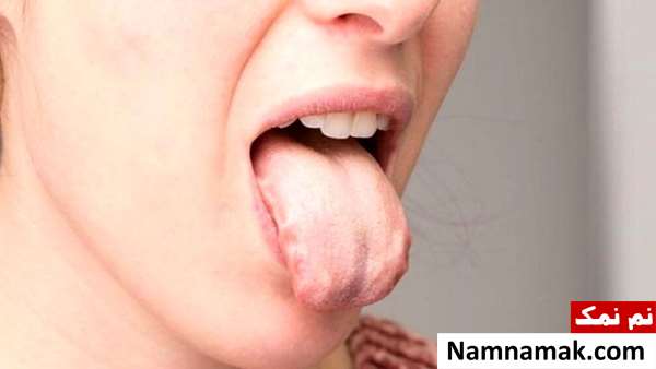 علت سوزش زبان و گلو چیست؟