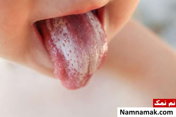 علت سوزش زبان و گلو چیست؟