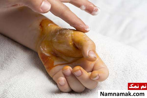 کارهای بعد از سوختگی