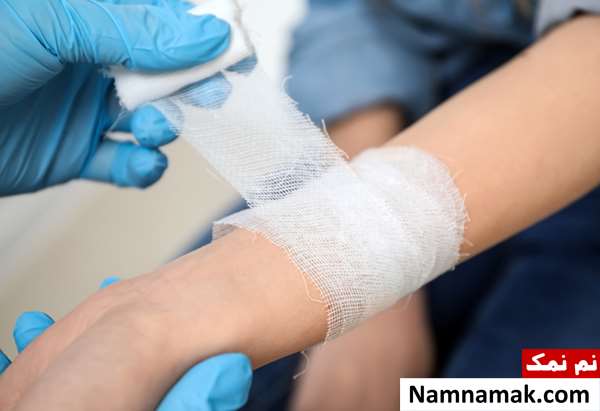 کارهای بعد از سوختگی