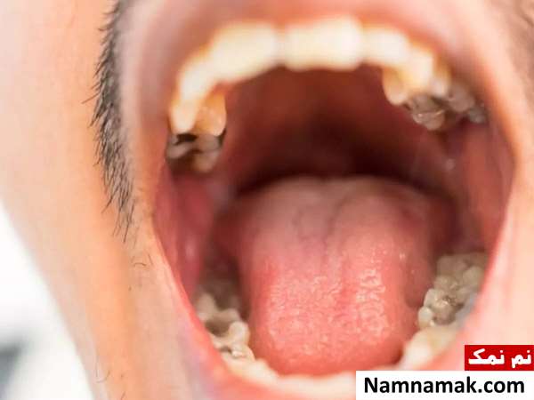 سرطان حلق و دهان سرطان حلق و دهان