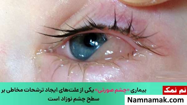 درمان قی کردن چشم کودک و نوزاد