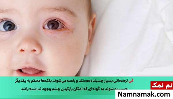 درمان قی کردن چشم کودک و نوزاد