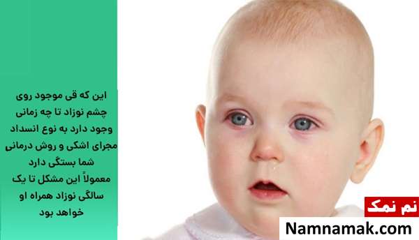 درمان قی کردن چشم کودک و نوزاد