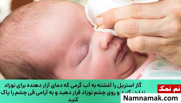 درمان قی کردن چشم کودک و نوزاد