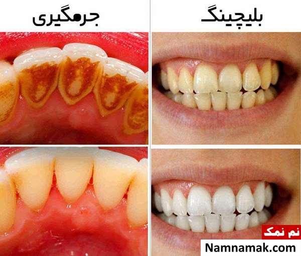 آیا جرم گیری برای دندان مضر است؟