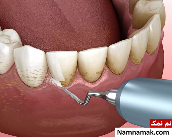 آیا جرم گیری برای دندان مضر است؟