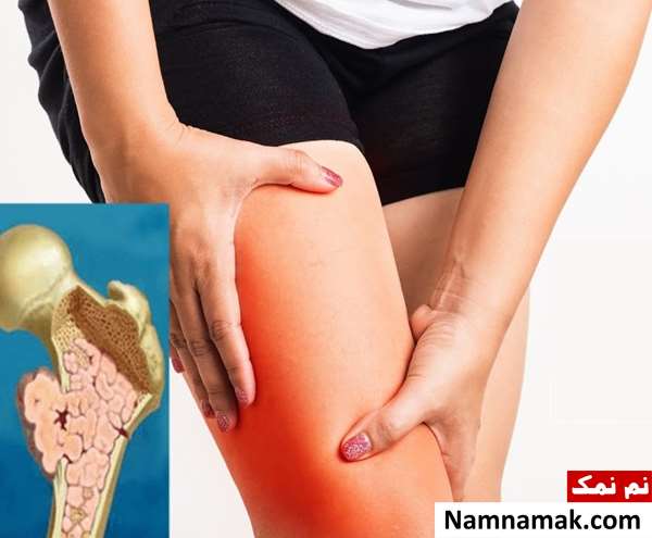 علائم و نشانه های سرطان استخوان علائم و نشانه های سرطان استخوان