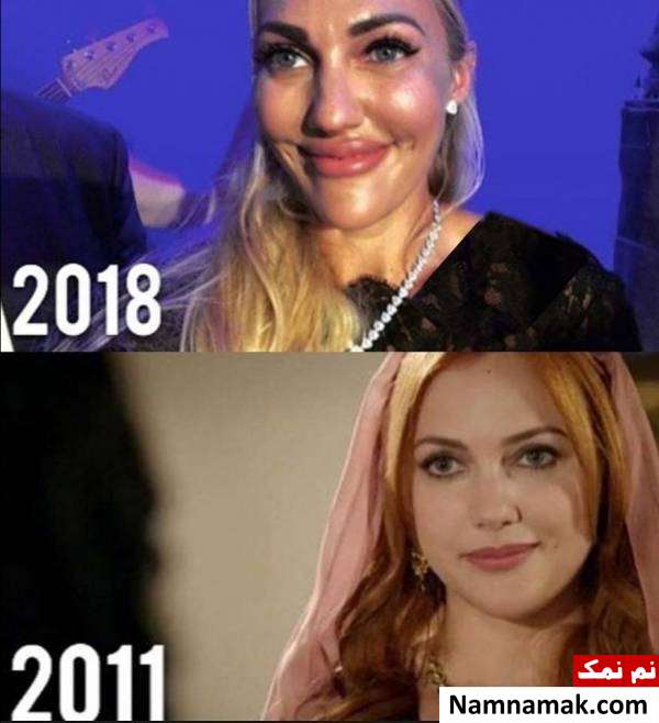 افتضاح بوتاکس صورت مریم اوزرلی خرم سلطان مریم اوزرلی بعد از عمل