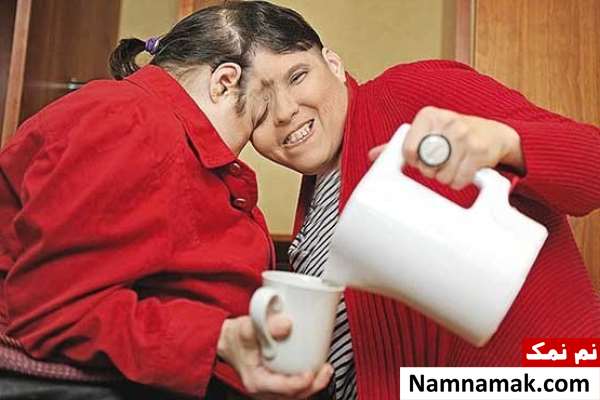 دوقلوهای به هم چسبیده لوری و جورج شاپل