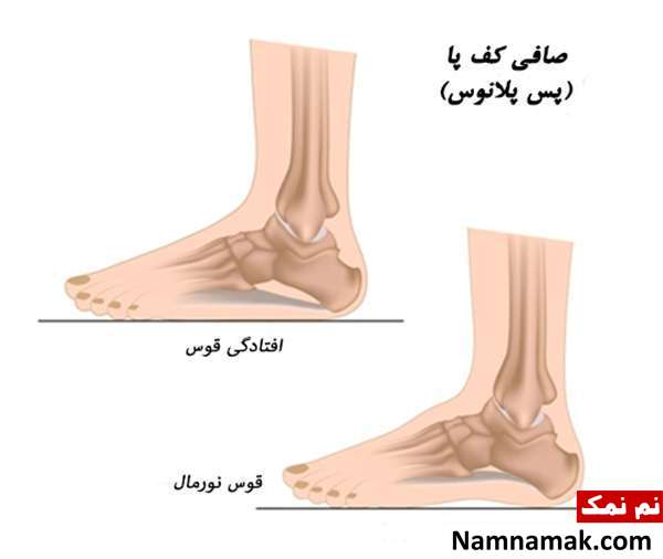 انواع صافی کف پا انواع صافی کف پا
