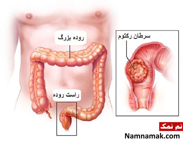 روش درمان قطعی سرطان رکتوم یا راست روده روش درمان قطعی سرطان رکتوم یا راست روده