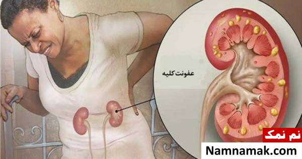 تشخیص عفونت کلیه 