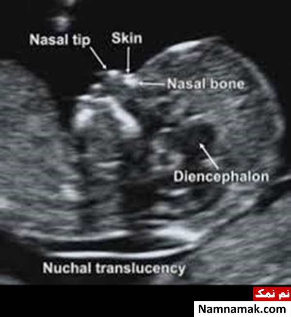 ارزیابی NB در جنین 
