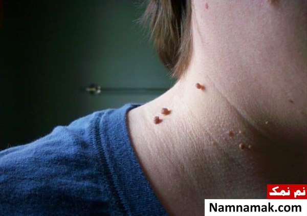 خواص و مضرات سیر زائده های گوشتی