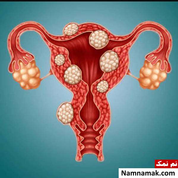 فیبروم رحمی نشانه های فیبروم