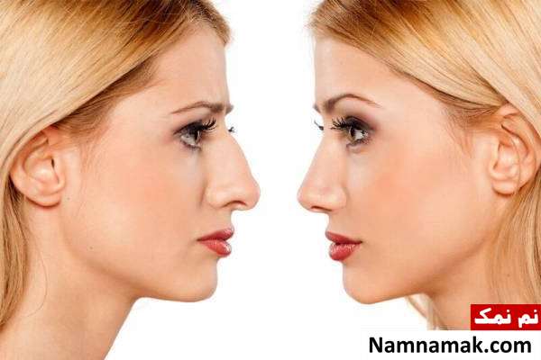 انحراف تیغه بینی به چه علت رخ می دهد؟