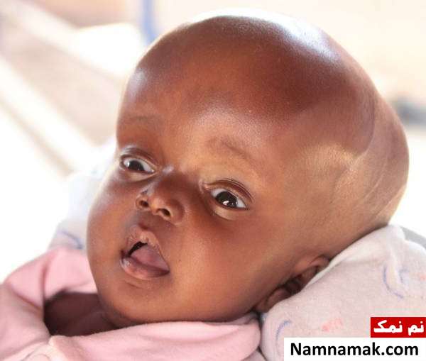 hydrocephalus disease سر بزرگ در هیدروسفالی