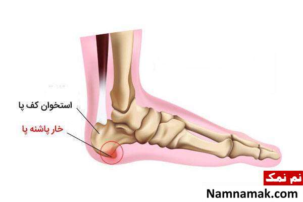 درمان خار پاشنه درمان های خار پاشنه
