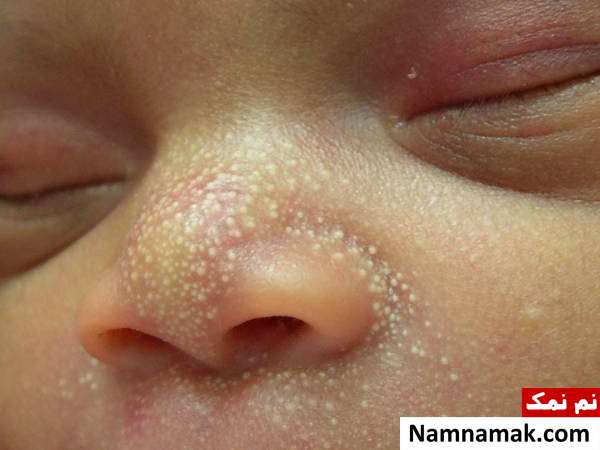جوش های سفید زیر پوستی یا میلیا در نوزادان چه علتی دارد؟