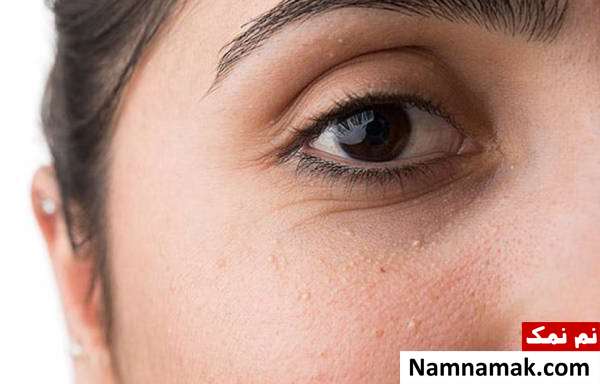 انواع جوش های سفید زیر پوستی یا میلیا