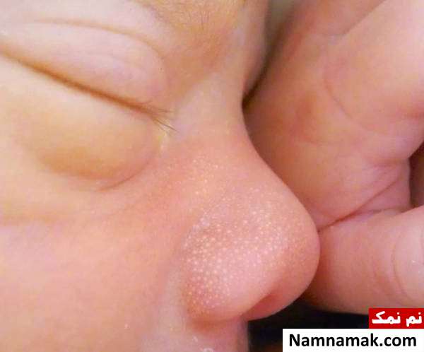 دلایل ایجاد جوش های سفید زیر پوستی یا میلیا در نوزادان