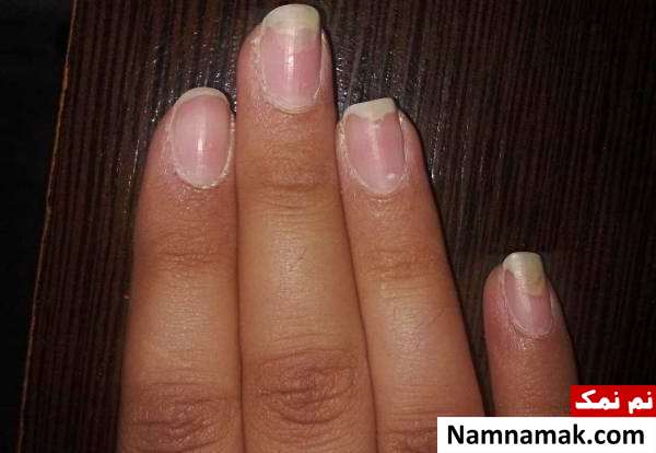 قارچ ناخن آسیبهای ناخن