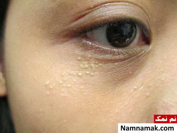 علل گوناگون جوش های سفید زیر پوستی یا میلیا
