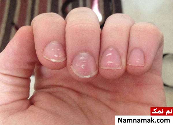 علائم ناخن سفیدک های روی ناخن