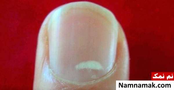 کمبود کلسیم ارتباط سفیدی ناخن و کلسیم