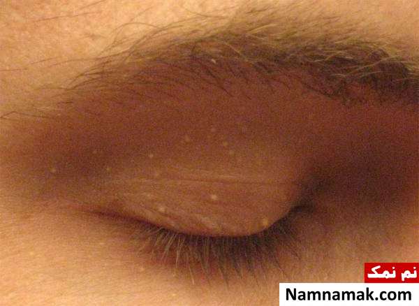 روش های جلوگیری از جوش های سفید زیر پوستی یا میلیا
