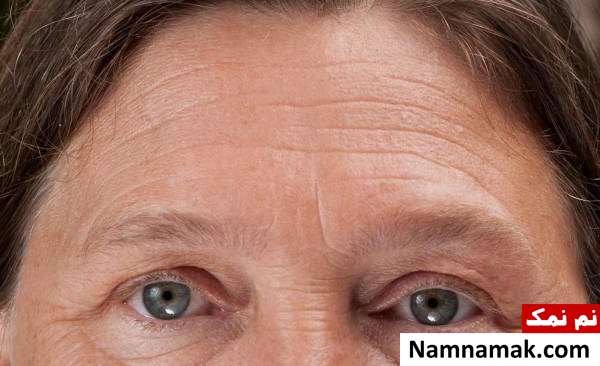 Eyebrow wrinkles علت خط اخم