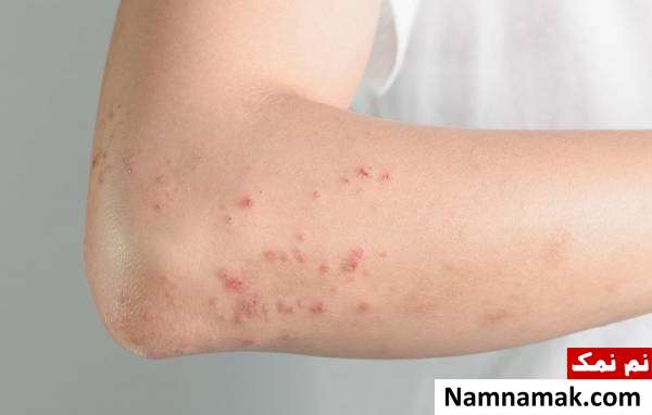 آنژیوادم چیست؟ دانستنی های آنژیوادم
