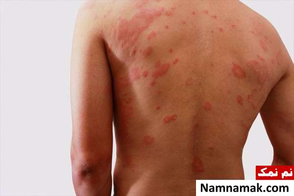 عوامل کهیر کهیر به چه علت رخ می دهد؟