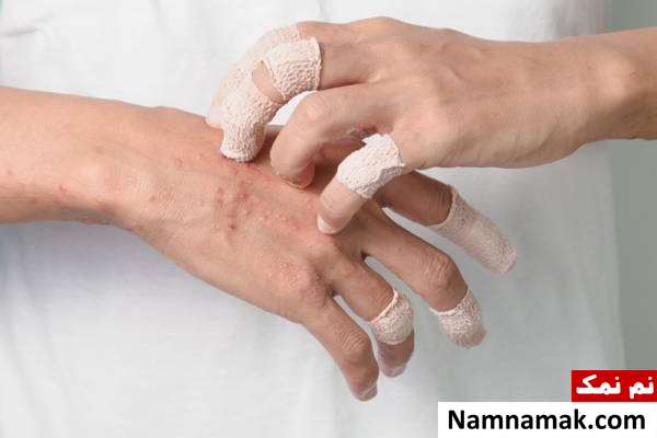 کهیر بدنی کهیرهای گرمایی