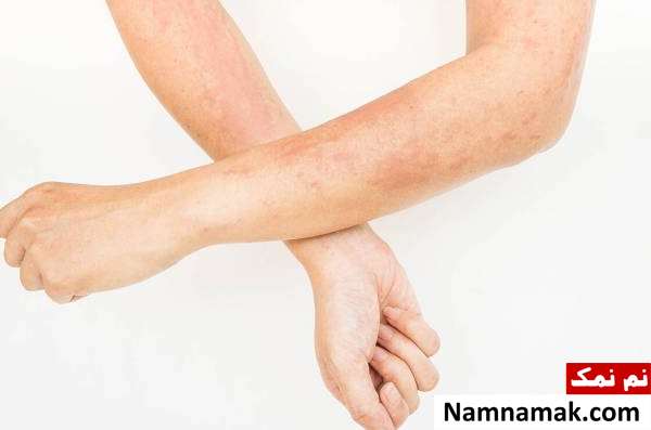شرایط بروز کهیر کهیر در چه شرایطی رخ می دهد؟