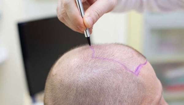 کاشت مو به روش bht چیست؟ کاشت مو به روش bht چیست؟