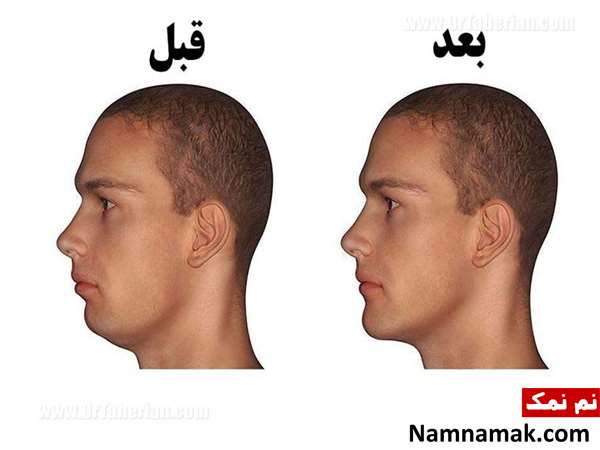 بزرگ کردن چانه
