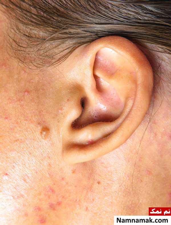 جوش زیر گوش نشانه چیست؟ جوش زیر گوش نشانه چیست؟