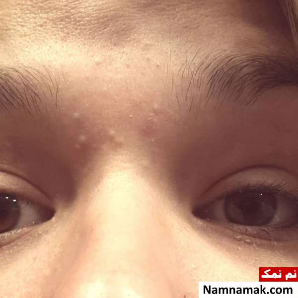 جوش بین ابرو نشانه جوش بین ابرو نشانه