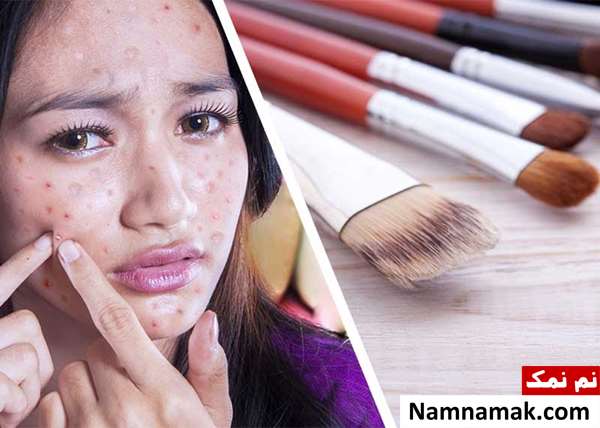 جوش روی گونه و لپ جوش روی گونه و لپ